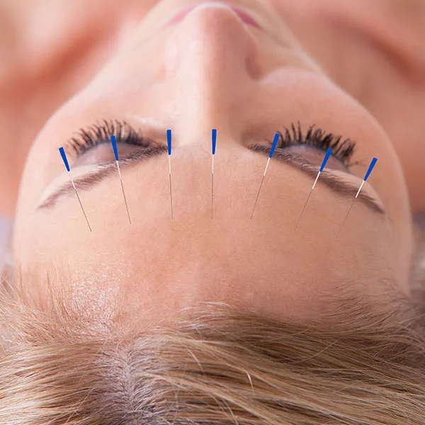 Kosmetische Akupunktur, in Essen.